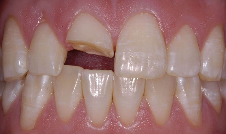 Broken or fractured teeth Broken or fractured teeth