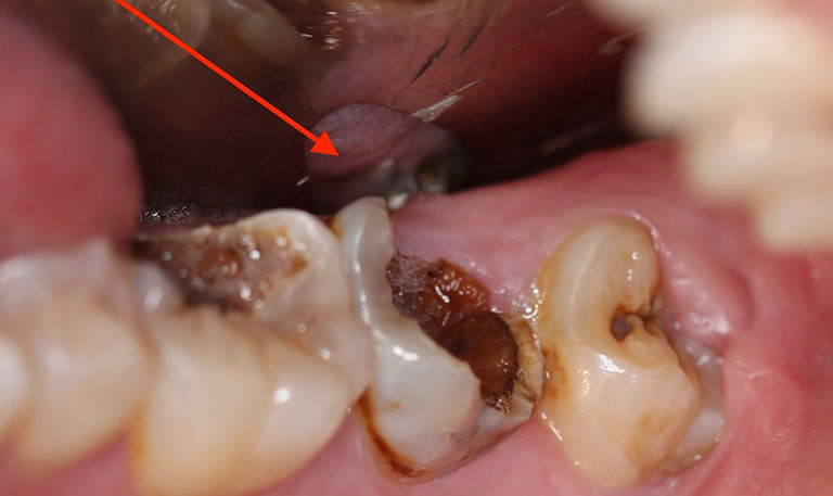Tooth has a root canal Tooth has a root canal
