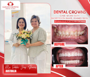 dental crowns before after 1 dental crowns before after 1