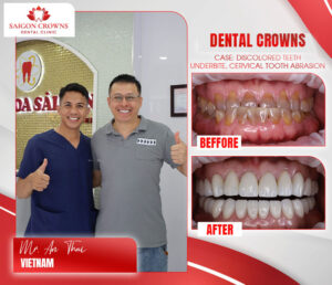dental crowns before after 11 dental crowns before after 11