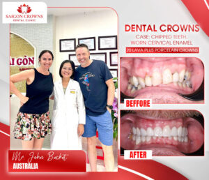 dental veneers before after 1 2 dental veneers before after 1 2
