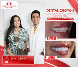 dental veneers before after 2 2 dental veneers before after 2 2