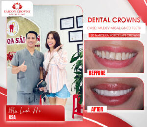 dental veneers before after 3 2 dental veneers before after 3 2