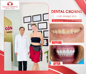 dental veneers before after 4 2 dental veneers before after 4 2