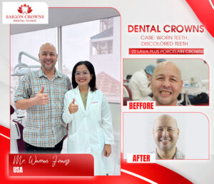 dental veneers before after 5 2 dental veneers before after 5 2