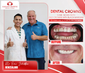 dental veneers before after 6 2 dental veneers before after 6 2