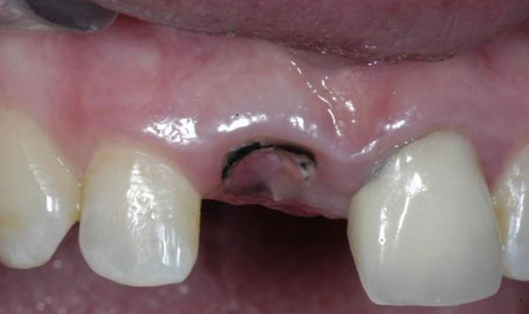 lost tooth lost tooth