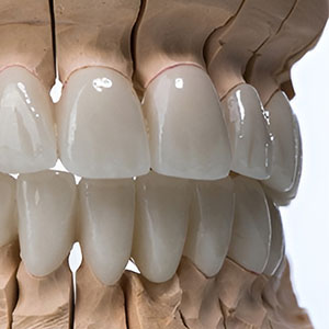 zirconia 1x1 1 zirconia 1x1 1